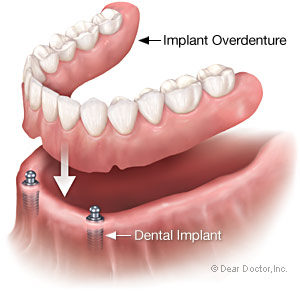 implant-overdenture