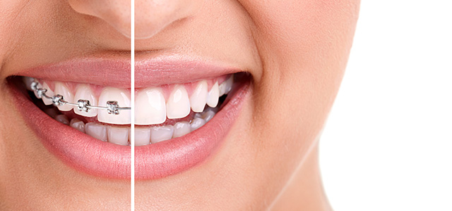 Ceramic Braces Adelaide - Clear Orthodontics - Orthodontic Smile Practice